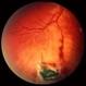Intraocular Foreign Body, Metallic, in Inferior Retina with Hemorrhage Intraocular Foreign Body, Metallic, in Inferior Retina with Hemorrhage